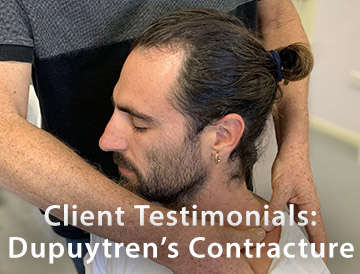 CLIENT TESTIMONIALS: Dupuytren's Contracture