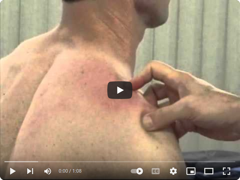 Video: Supraspinatus Insertion Stroke